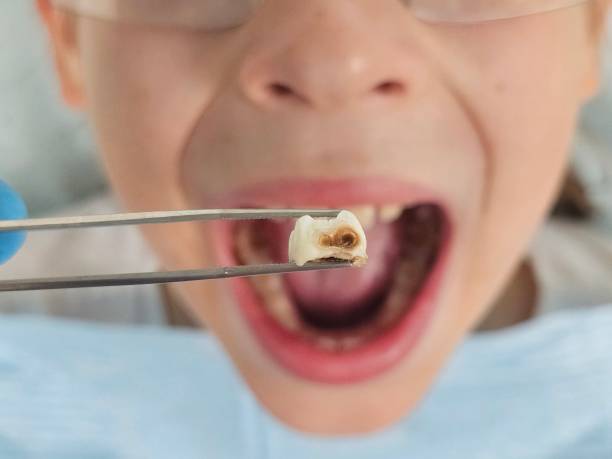 Best Emergency Wisdom Teeth Removal in Pawcatuck, CT
